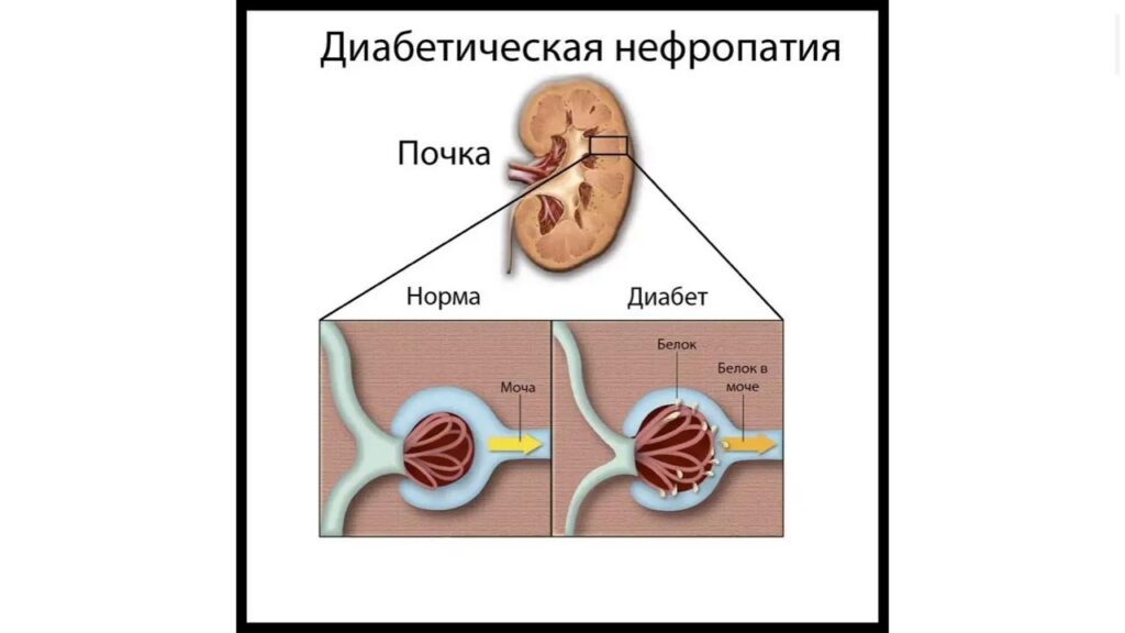 школа диабета